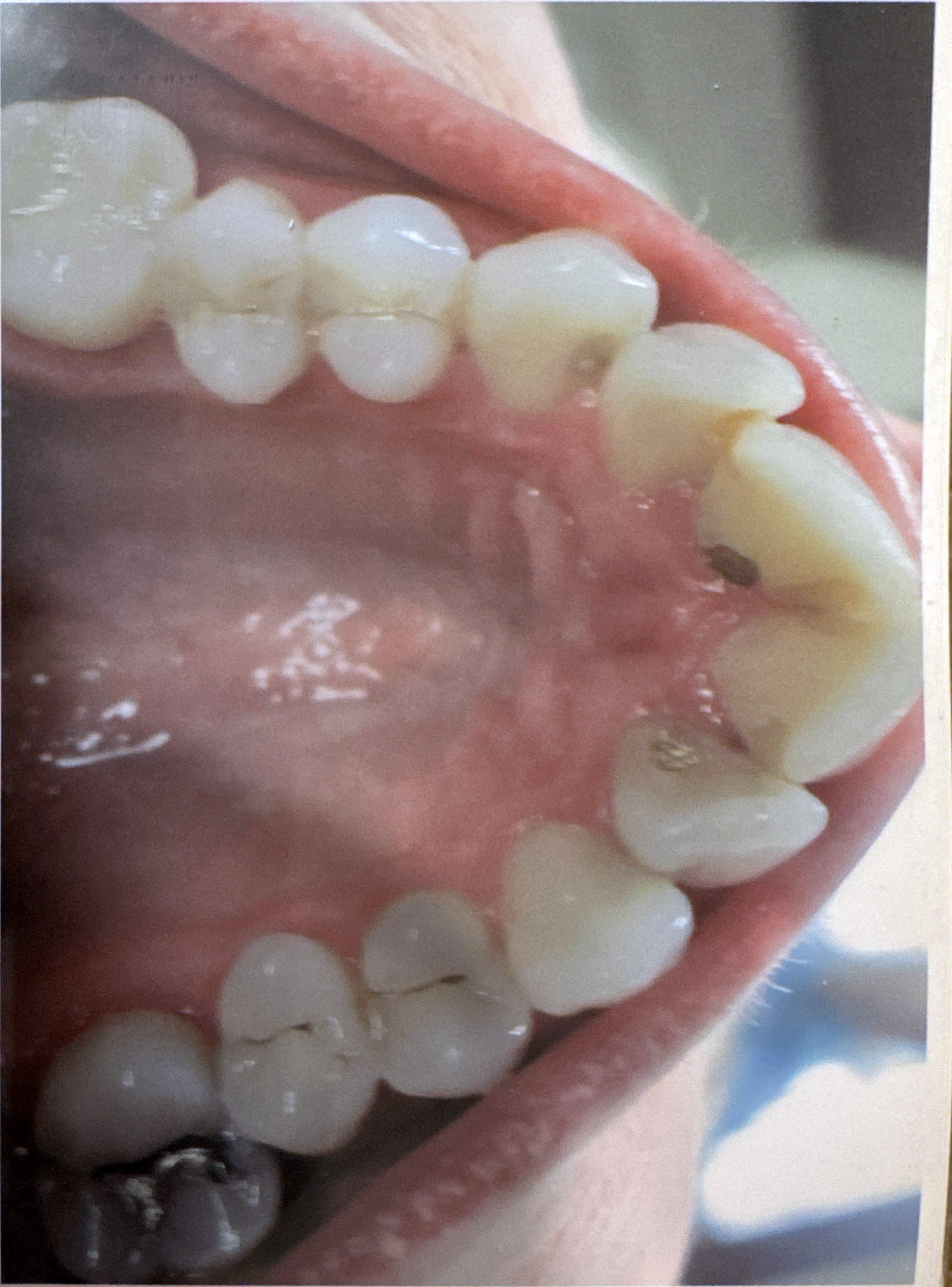 Teeth alignment before Invisalign